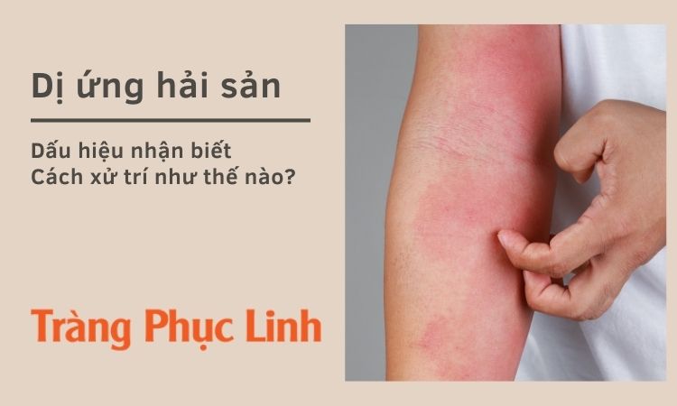 4. Phòng ngừa dị ứng hải sản: Các lời khuyên hữu ích